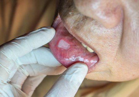 Photo for Aphthous ulcer or stress ulcer in the mouth of Asian male patient. - Royalty Free Image