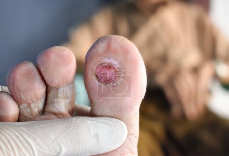 Photo for Diabetes foot ulcer in the big toe of Asian male patient. - Royalty Free Image