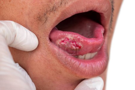 Foto de Carcinoma escamoso de lengua. Cáncer oral o tumor maligno del paciente masculino asiático. - Imagen libre de derechos