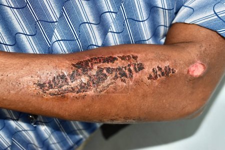 Abrasions and scabs in the upper arm of Asian male patient. Trauma and injury in the forearm.