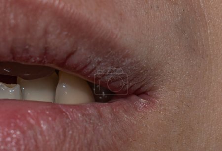 Lèvre supérieure sèche, fissurée et déshydratée du jeune homme asiatique.