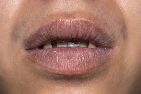 Photo for Dry, cracked and dehydrated lips of Asian young man. - Royalty Free Image