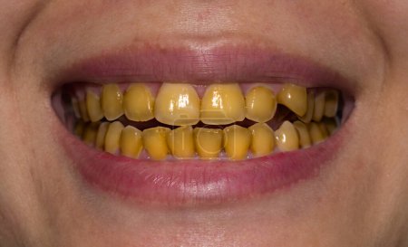 Photo for Small teeth with yellow colored tobacco stains. Poor oral hygiene. - Royalty Free Image