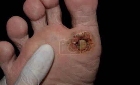 Photo for Diabetes foot ulcer in the sole of Asian male patient. - Royalty Free Image