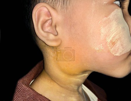 Photo for Painful and large cheek or jaw swelling or submental and submandibular cellulitis due to dental caries in Southeast Asian male child. - Royalty Free Image