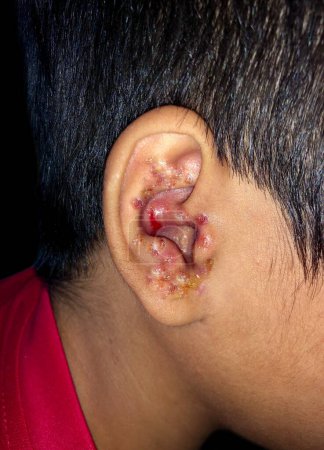 Photo for Multiple impetigoes or numerous Staphylococcal skin infection in the ear of Southeast Asian child. - Royalty Free Image
