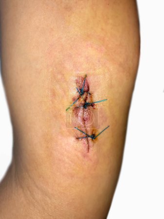 Foto de Stitched wound in the arm of Southeast Asian woman. - Imagen libre de derechos
