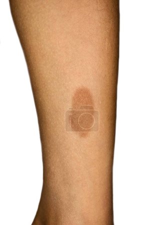 Foto de Birthmark on the leg of Southeast Asian child. It is congenital, benign irregularity on skin and caused by overgrowth of blood vessels, melanocytes, smooth muscle, fat, fibroblasts, or keratinocytes. - Imagen libre de derechos