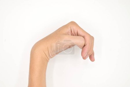 Foto de Cerebral palsy hand in Southeast Asian young male patient. Typically seen in hemiplegia and quadriplegia. Wrist joint flexion with ulnar deviation - Imagen libre de derechos