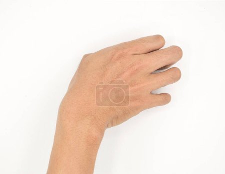 Photo for Cerebral palsy hand in Southeast Asian young male patient. Typically seen in hemiplegia and quadriplegia. Wrist joint flexion with ulnar deviation - Royalty Free Image