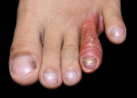 Foto de Tinea Pedis or or Athlete foot or Fungal Infection on toes of Asian, Burmese child. It is a superficial dermatophyte infection limited to glabrous skin of leg. - Imagen libre de derechos