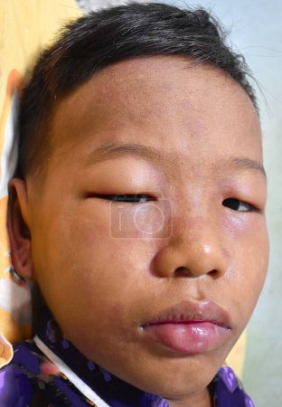 Angioedema at eyelids and lips of Southeast Asian male child. Edematous child. Caused by drug, seafood or chemical allergy and insect bite.