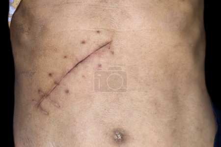 Téléchargez les photos : Scar of Kocher incision at abdomen of the elder woman. - en image libre de droit