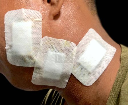 Photo for Sterile transparent island dressings on the face . Multiple facial injuries. Wound care. - Royalty Free Image