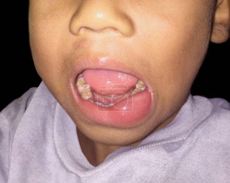 Photo for Angioedema at the lower lip of Asian male child. Caused by drug, seafood or chemical allergy and insect bite. - Royalty Free Image