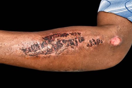 Foto de Abrasiones curadas con costras en el antebrazo de un paciente asiático. - Imagen libre de derechos