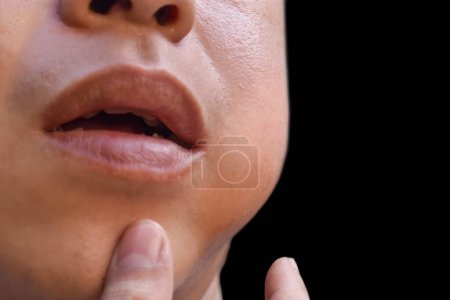 Photo for Swelling at the cheek of Asian young man. Inflammation of parotid gland called parotitis. Mumps. - Royalty Free Image