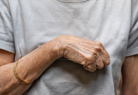 Photo for Volkmann contracture in left upper limb of Southeast Asianold  woman. It is a permanent shortening of forearm muscles that gives rise to a clawlike posture of the hand, fingers, and wrist. - Royalty Free Image