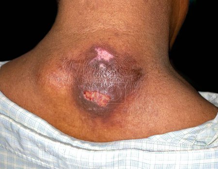 Foto de Large abscess with surrounding cellulitis or Staphylococcal, Streptococcal skin infection at the neck of Asian male patient. - Imagen libre de derechos
