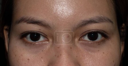 Téléchargez les photos : Freckles and brown spots on the oily face of Asian young woman. - en image libre de droit
