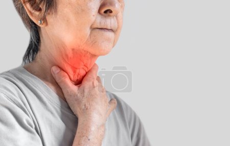 Photo for Redness at the neck of Asian, Myanmar woman. Concept of sore throat, pharyngitis, laryngitis, esophagitis, thyroiditis, or dysphagia. - Royalty Free Image