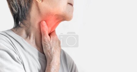 Foto de Redness at the neck of Asian, Myanmar woman. Concept of sore throat, pharyngitis, laryngitis, esophagitis, thyroiditis, or dysphagia. - Imagen libre de derechos