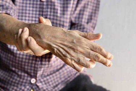 Photo for Ulnar claw hand of Asian elder woman. It develops due to ulnar nerve damage . - Royalty Free Image