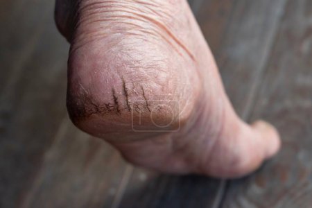 Painful cracked heel of Asian elder woman. Dry foot skin.