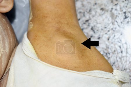 Photo for Painful large swelling at axillary area in Southeast Asian child. Diagnosis is lymphadenopathy. The traditional topical medicine is applied on the swelling. - Royalty Free Image