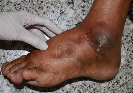 Photo for Pitting edema of lower limb. Swollen leg of Asian old man. - Royalty Free Image
