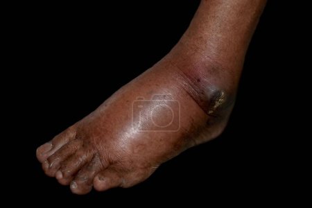Photo for Unilateral edema of upper limbs. Swollen leg and foot of Asian man. Isolated on white. - Royalty Free Image