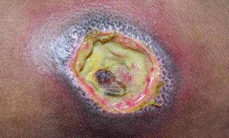 Photo for Bed sore aslo called pressure ulcer at tha back. Closeup view. - Royalty Free Image