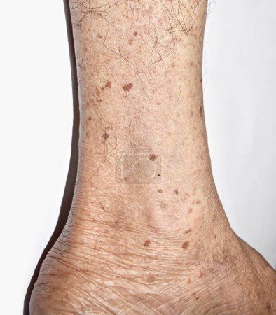 Téléchargez les photos : Des taches de vieillesse sur la jambe d'un aîné asiatique. Ce sont des taches brunes, grises ou noires et aussi appelées taches hépatiques, lentigo sénile, lentigines solaires ou taches solaires.. - en image libre de droit