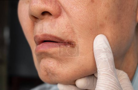 Photo for Angular stomatitis or angular cheilitis or perleche in asian elder man. Mouth ulcer. Common inflammatory condition caused by iron, zinc or B12 deficiency, or repetitive trauma. - Royalty Free Image
