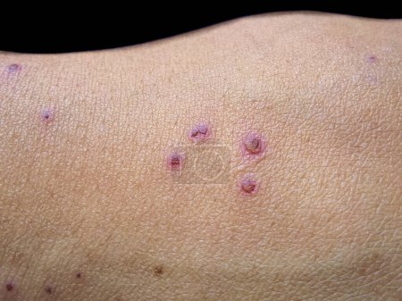 Photo for Itching skin lesions with scabs on the hand. Closeup view - Royalty Free Image