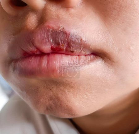 Téléchargez les photos : Lèvres sèches, fissurées et déshydratées du patient asiatique - en image libre de droit
