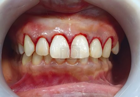 Gum bleeding in upper jaw. Closeup view
