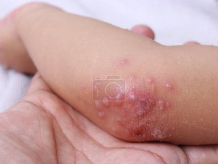 hfmd viraler Hautausschlag am Ellbogen der Hand-Maul- und Klauenseuche. Maul- und Klauenseuche wird am häufigsten in der Regenzeit verursacht