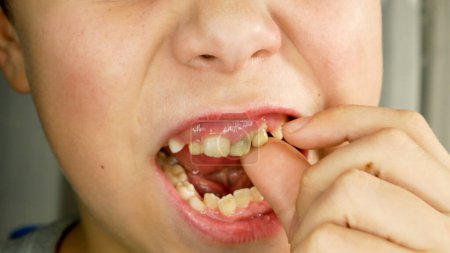 Téléchargez les photos : L'enfant secoue le doigt de la dent de lait. La bouche ouverte, d'autres dents sont visibles. Changement de dents chez les enfants. Soins dentaires chez les enfants. Dentisterie pédiatrique - en image libre de droit