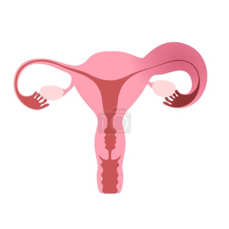 Illustration for Flat illustration of human uterus demonstrating one healthy and one inflamed fallopian tube. Vector illustration - Royalty Free Image