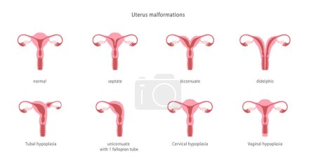 Malformaciones uterinas humanas. Conjunto de historias clínicas. Ilustración vectorial