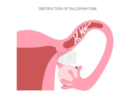 Flat chart of Fallopian tube obstructed. Blockage of womb tube high magnification scheme. Vector illustration