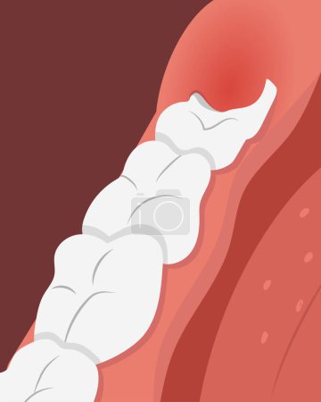 Illustration of teeth row with inflamed gum over the growing wisdom tooth. Vector illustration