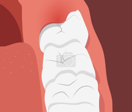 Illustration de rangée de dents avec gomme enflammée sur la dent de sagesse croissante. Illustration vectorielle