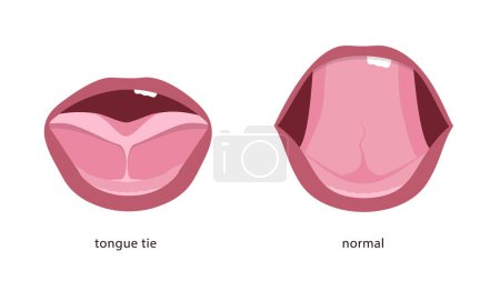 Ilustración de Lazo de lengua de un bebé antes y después de la cirugía. Ilustración vectorial - Imagen libre de derechos