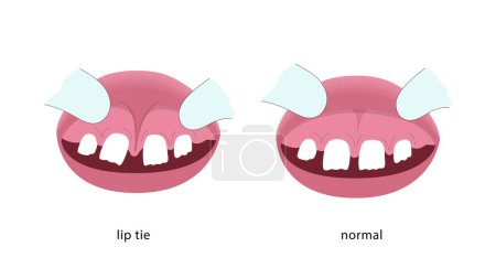 Illustration for Lip tie illustration before and after surgery. Vector illustration - Royalty Free Image