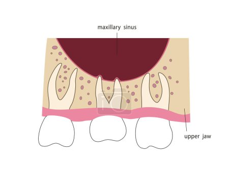 Ilustración de Raíces dentales en seno maxilar. Ilustración médica en estilo plano. Ilustración vectorial - Imagen libre de derechos
