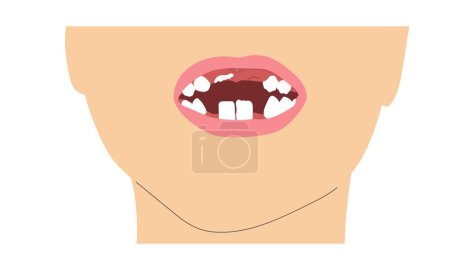 Ilustración de A boy smile missing tooth due to change of milk teeth. Simple minimalistic illustration of baby mouth with incomplete set of teeth. Vector illustration - Imagen libre de derechos
