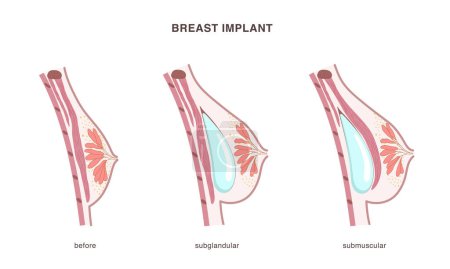 Illustration for Silicone implant placement under the gland and muscle in female breast. Side view cross section of before and after operation. Flat style chart. Vector illustration - Royalty Free Image