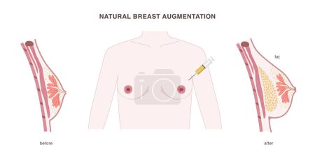 Illustration for Natural breast augmentation with fat transferred into the breast from other body parts. Fat tissue injection illustration with before and after effect. Vector illustration - Royalty Free Image